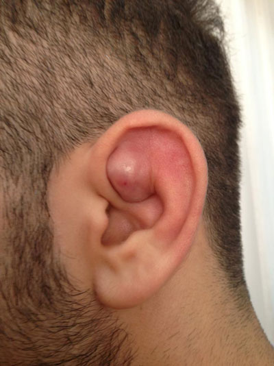small lump behind ear on bone - MedHelp